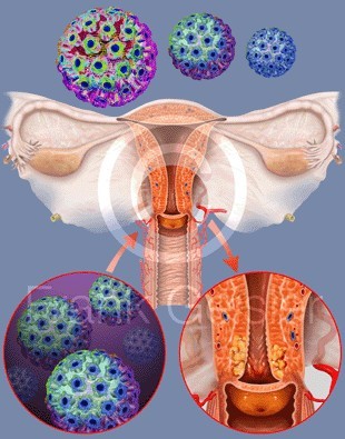 L'infezione da HPV | Noi Mamme