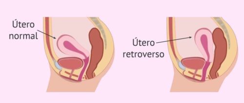 utero normale vs utero retroverso