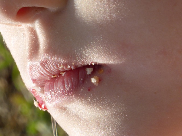 Varicella e inappetenza