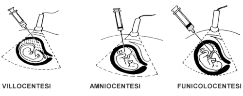 amniocentesi vs villocentesi vs funicolocentesi