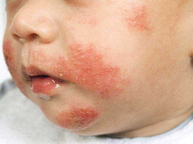 Dermatite Atopica nel bambino, come riconoscerla e prendersene cura in un’infografica. | Noi Mamme 2