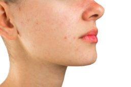 Rimedi naturali contro l'acne giovanile