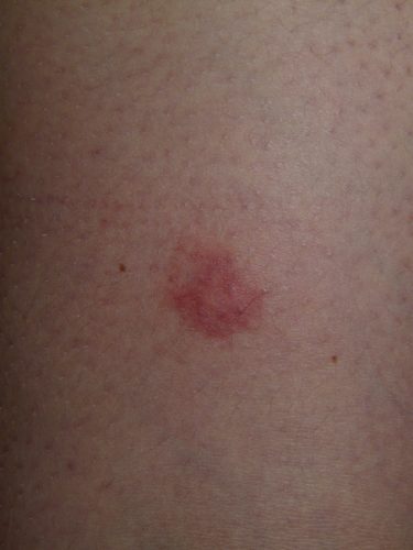 sintomi impetigine