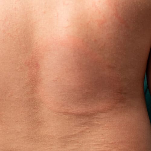 Eritema anulare sulla schiena di un bambino, malattia di Lyme
