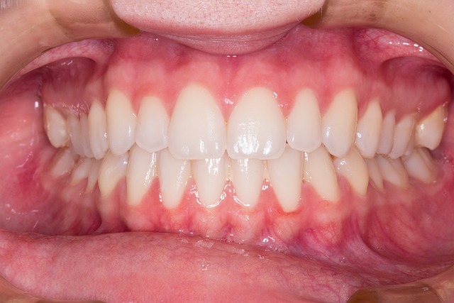 Denti Gialli: Cause e Soluzioni Efficaci per un Sorriso Smagliante