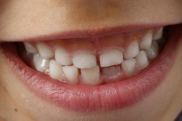 Macchie sui Denti da Latte e Tartaro nei Bambini: Cause e Soluzioni