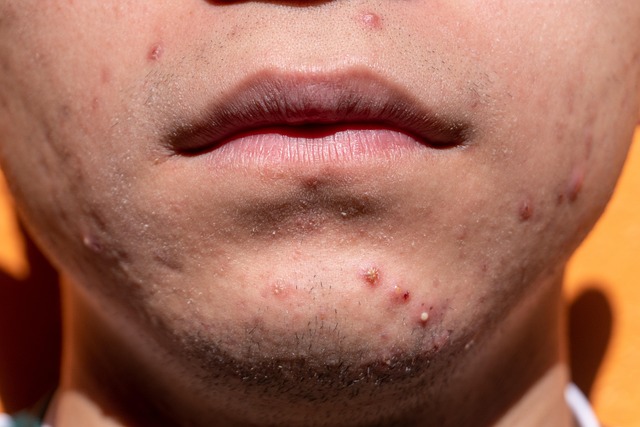 Acne Ormonale in Adolescenza: Guida Completa per la Cura